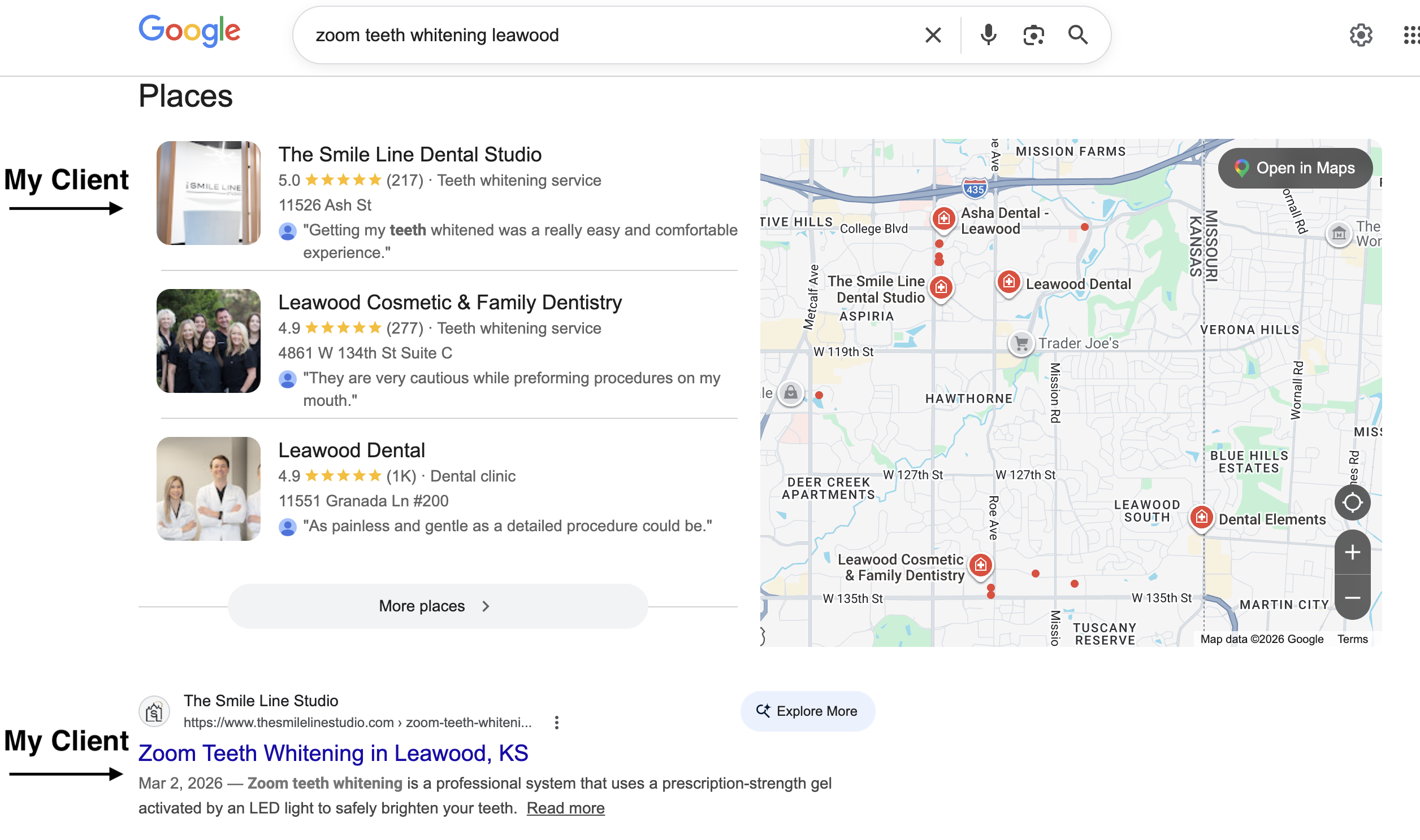 The Smile Line Studio ranking #1 in Google local pack for zoom teeth whitening Leawood